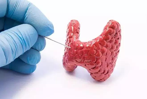 甲状腺疾病，包括甲状腺功能减退和甲状腺功能亢进，自古以来就是反复被医学研究人员研究的疾病